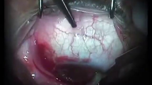 Хирургия птеригиума смотреть онлайн