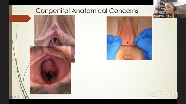 INwebinar: Amenorrhea. Evaluation And Management Of Primary And Secondary Causes