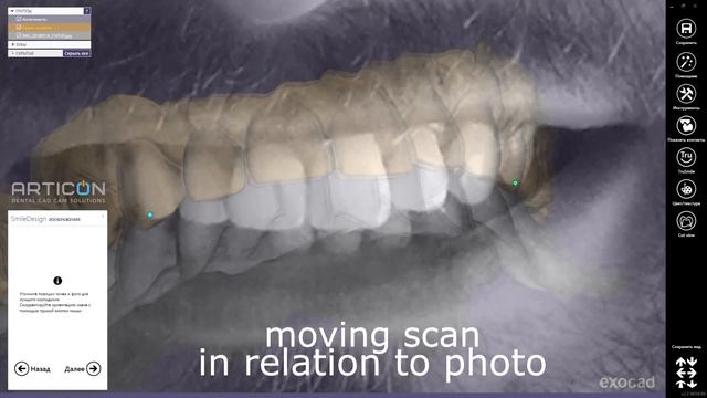 Smile Design Exocad - align photo to scan смотреть онлайн