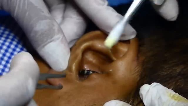 E.N.T. doctor try to remove insect (Kan se kide ko bahar nikalne ki kosis) смотреть онлайн