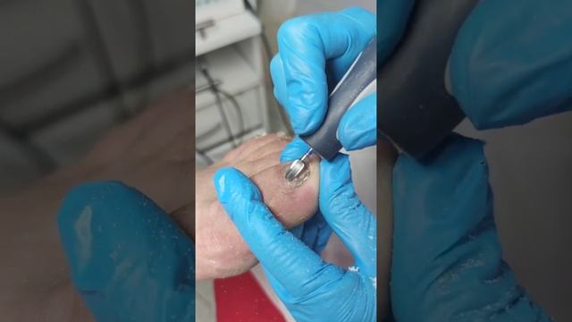 Твердосплавная фреза «Тайфун PRO» для педикюра и подологии Фэйт 02365 в работе смотреть онлайн