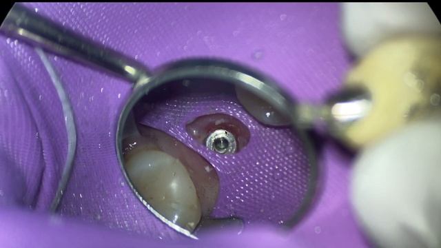 How to Remove a Cement Retained Implant Crown (Crown is Loose) смотреть онлайн