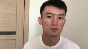 АКНЕКУТАН. РОАККУТАН. 22 день приема