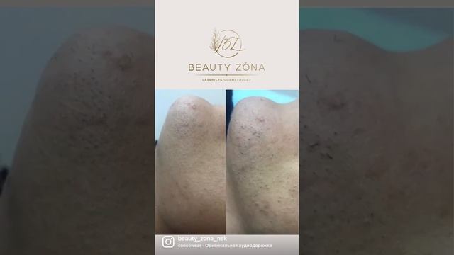 Результаты лазерной эпиляции. Новосибирск #лазернаяэпиляция #Новосибирск #уходзателом #гладкоетело смотреть онлайн
