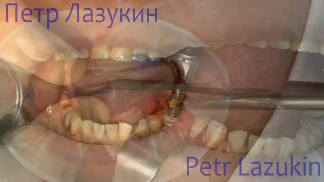 Титановая мембрана смотреть онлайн