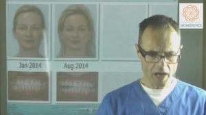 Расширение неба у взрослых. Доктор Мью.