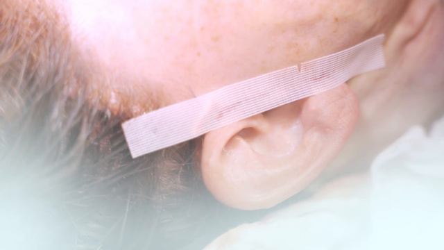 Facelift OP mit Halsstraffung VORHER / NACHHER Ergebnis 50-jährige Patientin | Dr. Walther Jungwirt смотреть онлайн