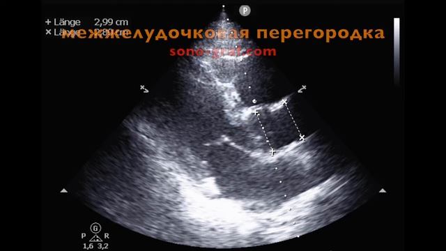 190 - Эхокардиография - Объяснение смотреть онлайн