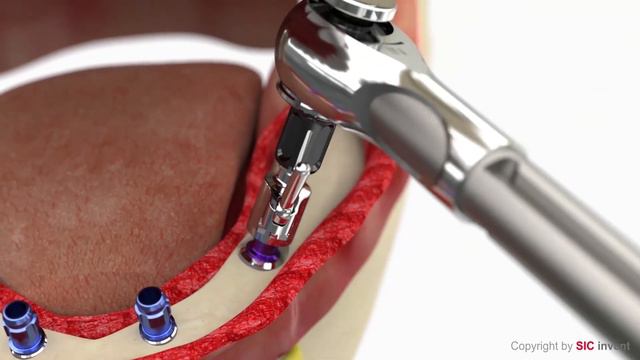 Multi-Unit Abutment: Prosthesis Overdenture SIC Safe On Four Solution