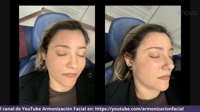 X MasterClass - Complicaciones en Armonización Facial - Dr. Thales Wilson смотреть онлайн