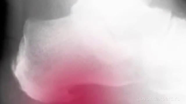 Пяточная Шпора. Как Быстро Вылечить Пяточную Шпору? Говорит ЭКСПЕРТ смотреть онлайн