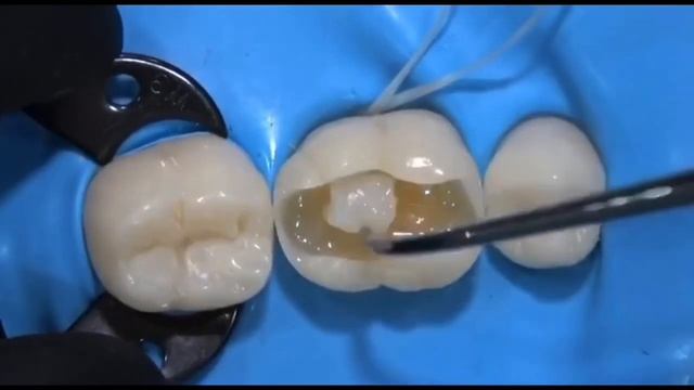 Как ставят пломбу на зуб ? смотреть онлайн