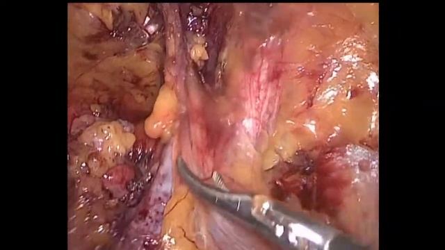 Laparoscopic (TAPP) inguinal hernia repair Лапароскопическая герниопластика ТАРР - 13 смотреть онлайн