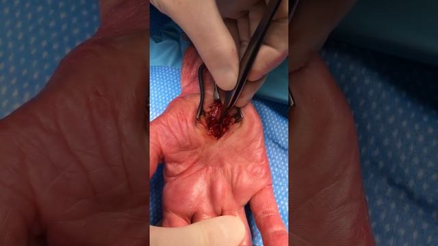 Carpal Tunnel Release abnormal tendon смотреть онлайн
