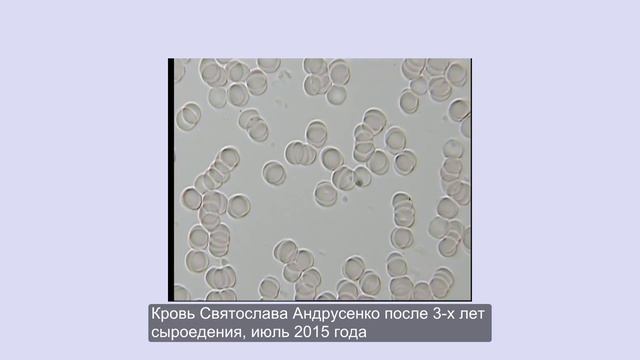 Гемосканирование крови на темнопольном микроскопе Андрусенко Святослава, 3 года сыроедения смотреть онлайн