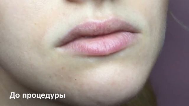Увеличение губ Исправление асимметрии смотреть онлайн
