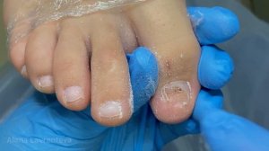 Ушибла палец / Протезирование ногтя / Отошел ноготь / #подология  /