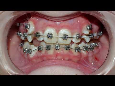 Комментируем фиксацию брекетов при скученном положении зубов #брекеты смотреть онлайн
