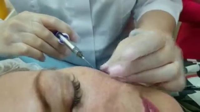 Контурная пластика против возрастных изменений