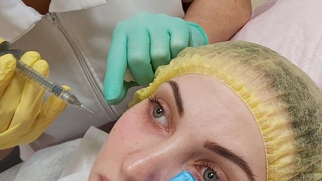 АирисКом студенты учатся: мезотерапия, заполнение морщин, удаление синяков. смотреть онлайн