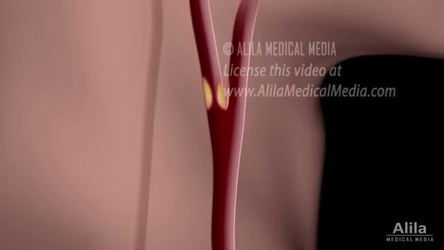 Carotid Stenosis And Carotid Endarterectomy, Animation