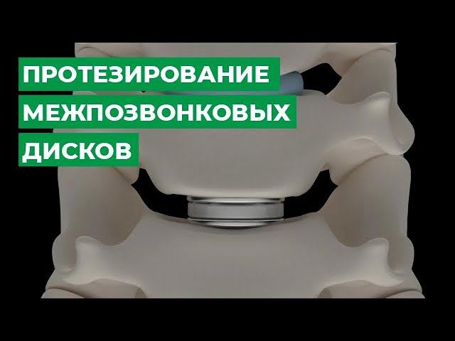 Протезирование межпозвонковых дисков смотреть онлайн