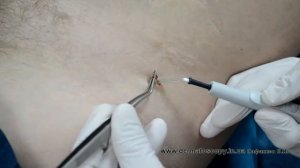 Папиллома, удаление методом высокочастотной электрохирургии