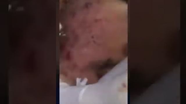 How To Removal LARGE Blackheads - Best Pimple Popping Videos part 2 смотреть онлайн