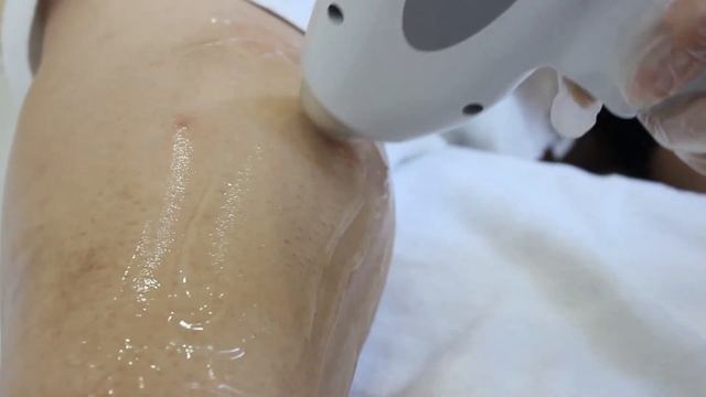 Non channel diode laser Clinical treatment смотреть онлайн