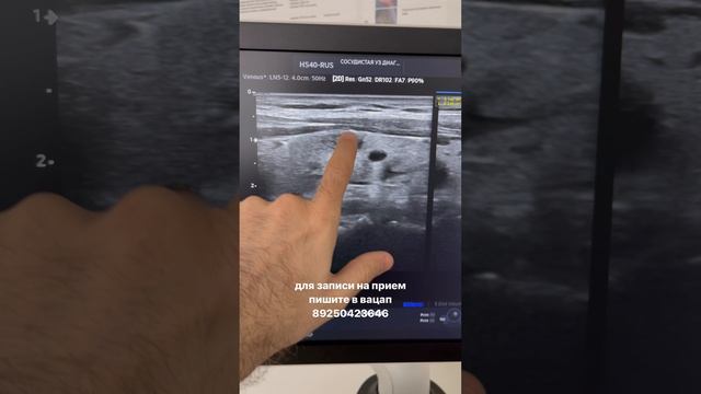 Узлы в щитовидной железе. Узи сосудов. Флеболог. Флеболог Москва смотреть онлайн