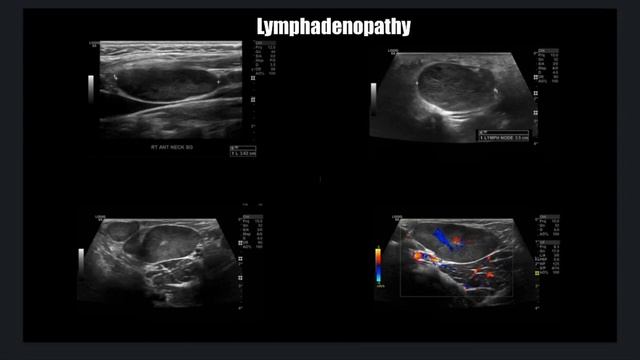 Sonoquickies - Cervical Lymphadenopathy смотреть онлайн