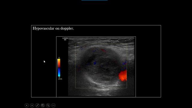 Ultrasound Case 48 - Pathological Inguinal L N смотреть онлайн