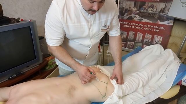 Как разблокировать седалищный нерв, снять ишиалгию, ущемление и синдром грушевидной мышцы? смотреть онлайн