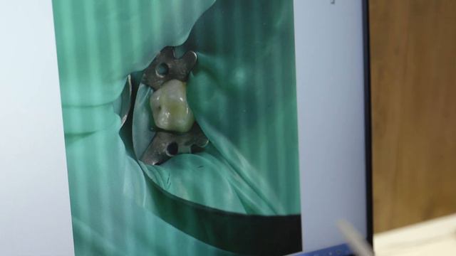 Фотопротокол лечение кариеса молочных зубов у детей смотреть онлайн