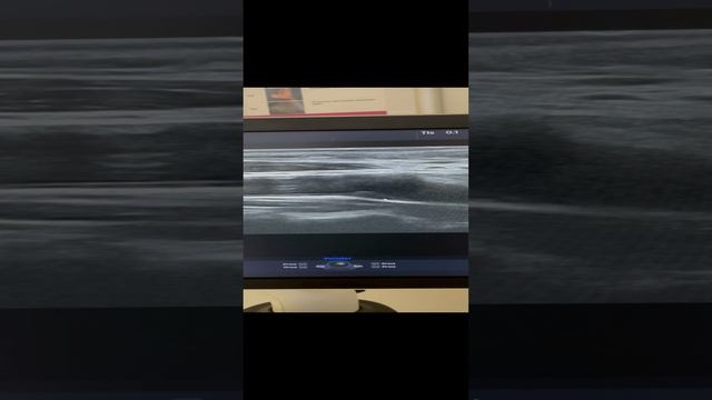 Узи сонных артерий. Бляшка. Атеросклероз. Как снизить холестерин? Лечение сосудов. Флеболог Москва. смотреть онлайн