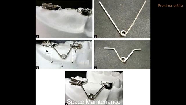 Сохранители места. Ортодонтия. смотреть онлайн