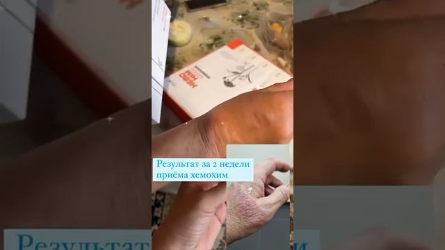 #хемохим Экзема. Результат полученный от приеме Хемо Хим. смотреть онлайн