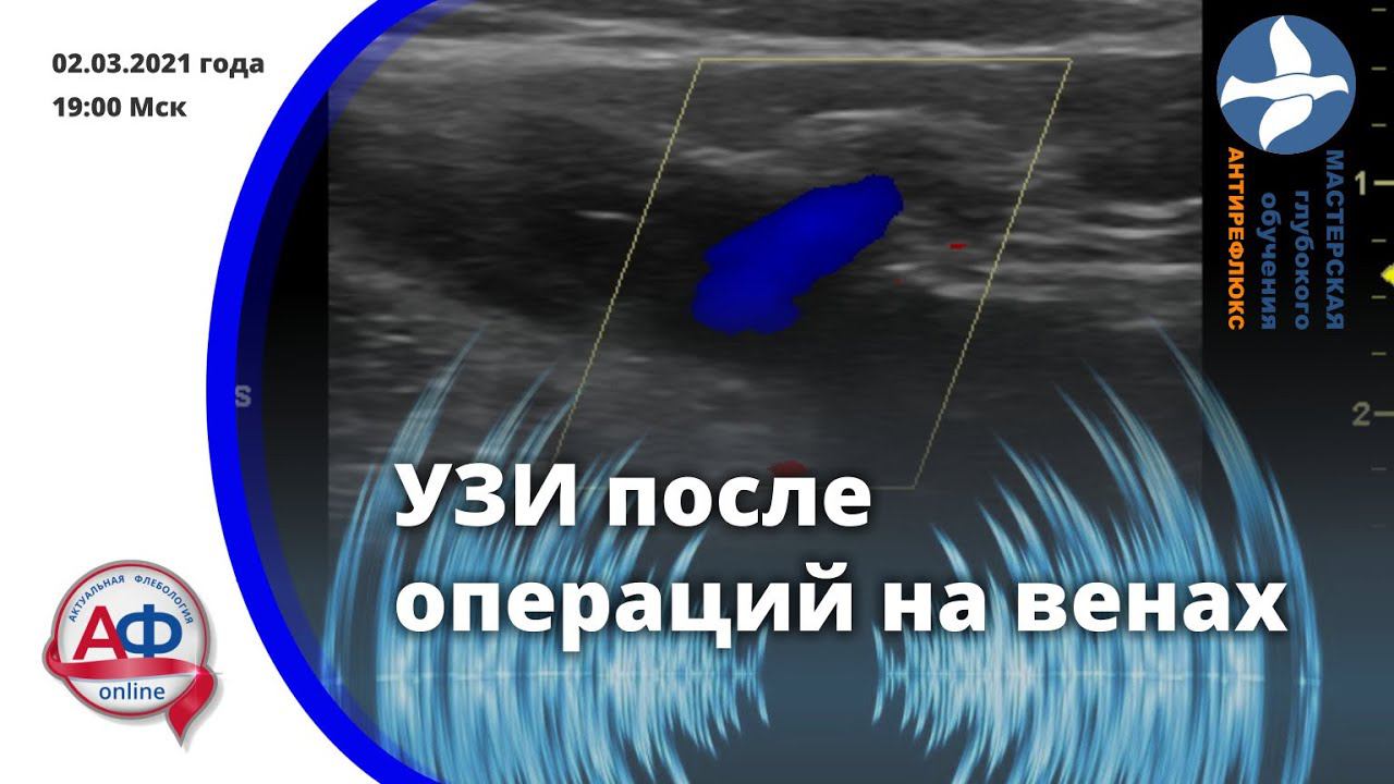Ультразвуковое исследование после операций на венах смотреть онлайн