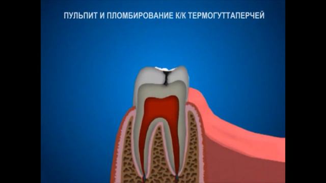 Пульпит или осложнение кариеса смотреть онлайн