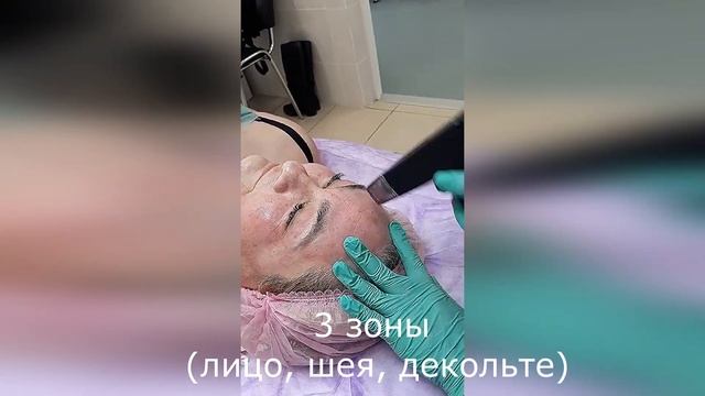 Микроигольчатый RF-лифтинг. смотреть онлайн