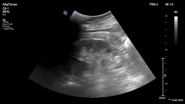 УЗИ правой почки. Злокачественная опухоль правой почки.. Ultrasound diagnostics. Kidney. Cancer. смотреть онлайн