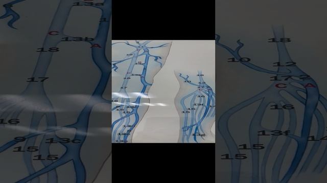 Тазовый варикоз у мужчины. Ожирение. Флеболог Москва. Флеболог. Сосудистый хирург смотреть онлайн