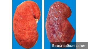 Нефрит. Как лечить нефрит.