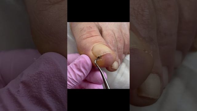 Врастающий ноготь.