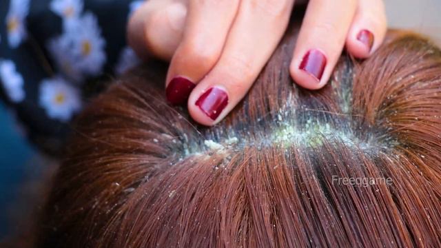 Huge Dandruff Flakes Removing And Picking ASMR # 968 смотреть онлайн