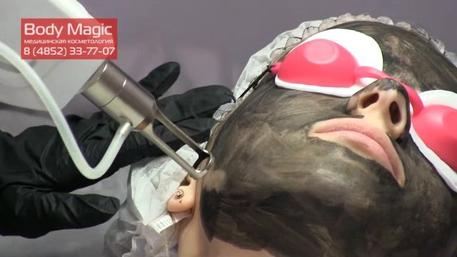 Карбоновый пилинг. Показания и проведение процедуры. Рекомендации после процедуры. смотреть онлайн