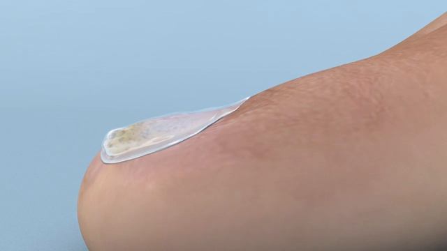 How Antifungal Nail Lacquer works смотреть онлайн