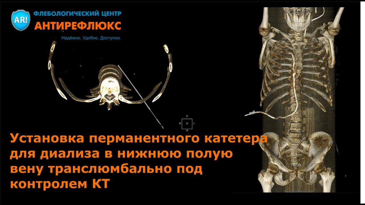 Установка катетера в нижнюю полую вену транслюмбально смотреть онлайн