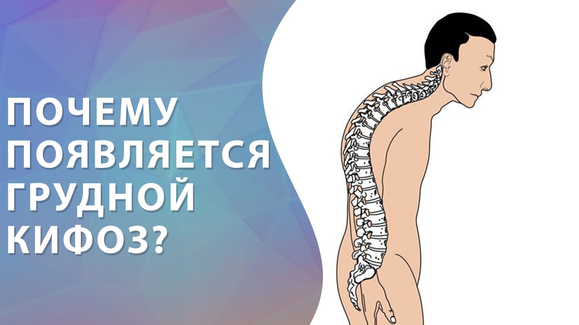 Грудной кифоз. Кифоз грудного отдела. Причины грудного кифоза