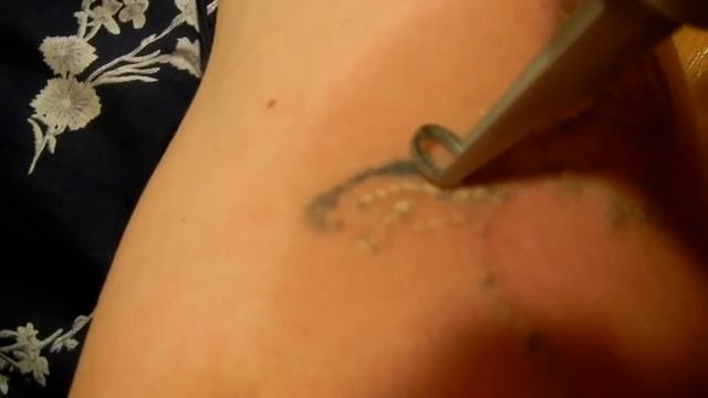 удаление татуажа и татуировок Уфа смотреть онлайн